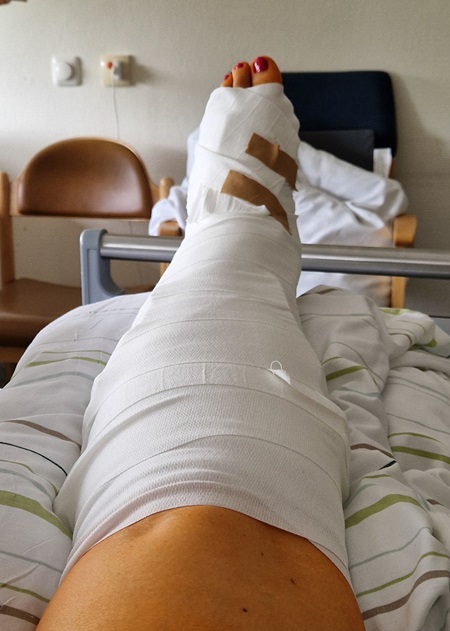 Ein Krankenhaus-Bett mit einem in Gips und Verbänden eingewickelten Bein